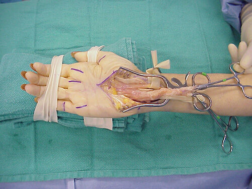 carpal-tunnel-syndrome-2