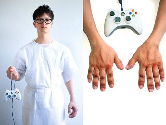 Cedera Nintendinitis yang dialami seorang gamer