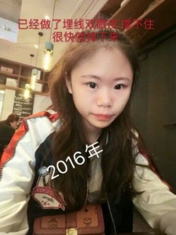 Xiao Z Na Na Sebelum Operasi 31fe3