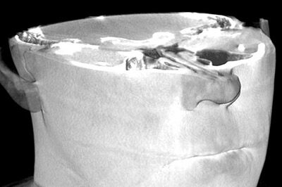 Mri Scan 12