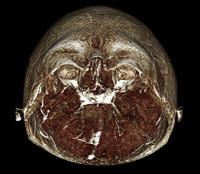 Mri Scan 6