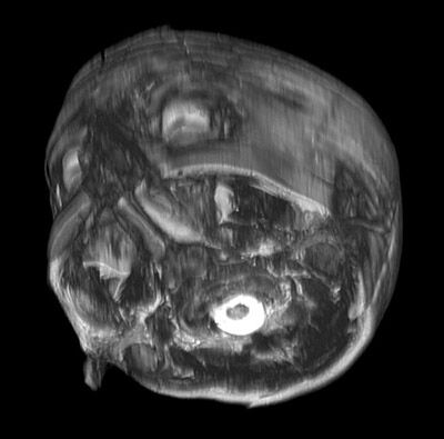 Mri Scan 13