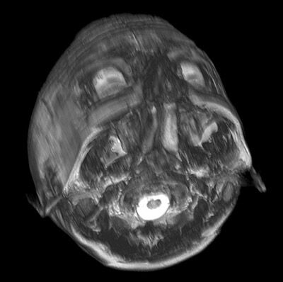 Mri Scan 11