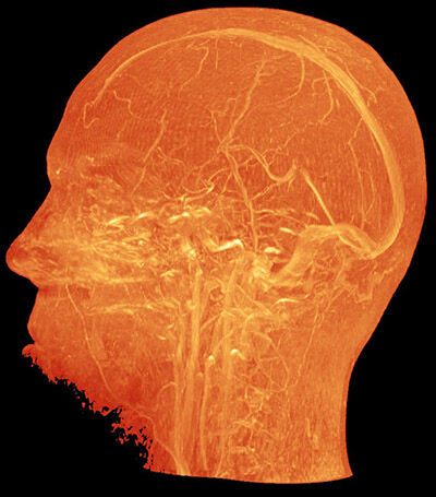 Mri Scan 10