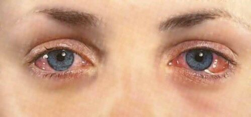 Eye Problem