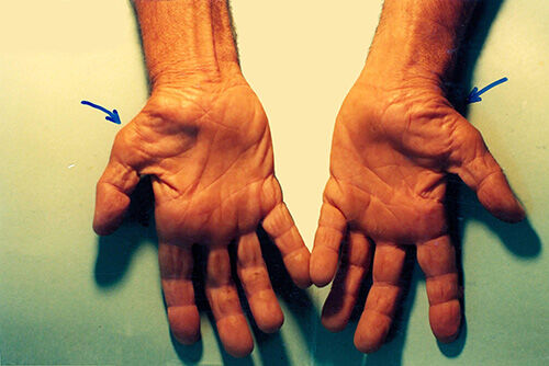 Carpal Tunnel Syndrome 1