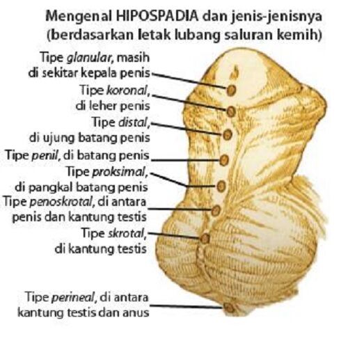 Hipospadia Pada Aprilia 1 Fe20a