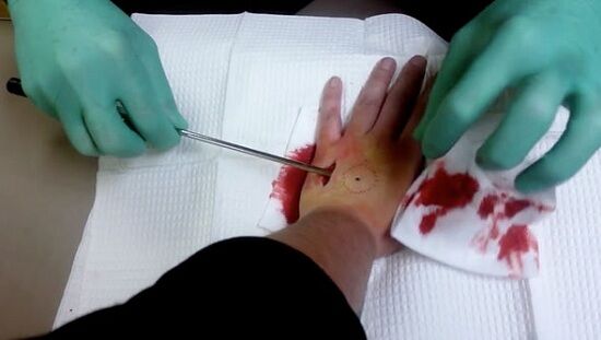 Iron Man Hand Technology Faze Iron Man Hand Procedure Body Manipulation Body Hacking Video Cyborg Video Gross 389496