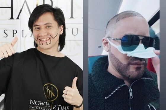 Kevin Aprilio Transplantasi Rambut 3 D88a2