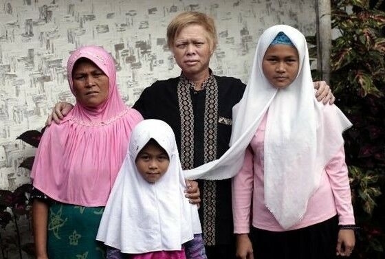 Warga Albino Di Kampung Ciburuy 0a660