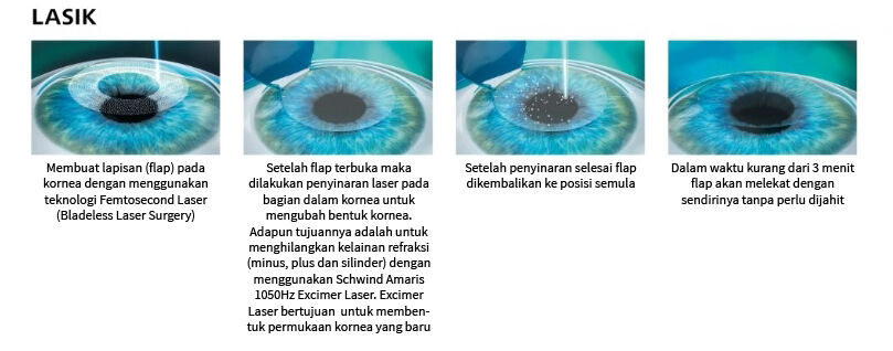 LASIK Steps