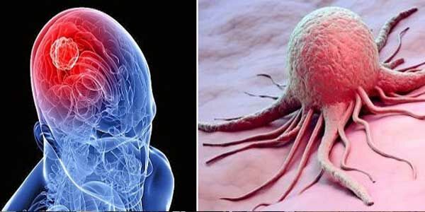 Tumor Otak F457b