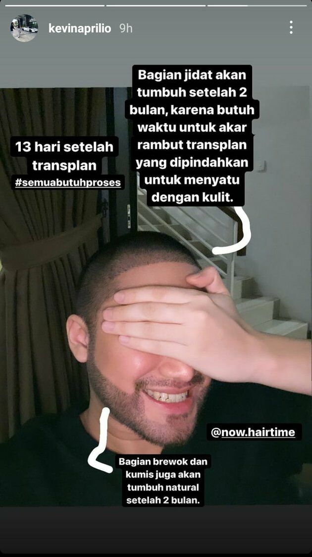 Transplantasi Kevin Aprilio Dibantu Now Hair Time 16d0c