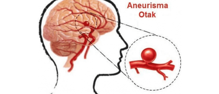 Aneurisma Adalah: Penyebab, Gejala, Pengobatan, Dan Pencegahan | JalanTikus